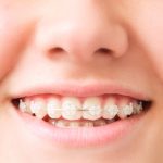 Clear Braces in Wesley Chapel, Florida